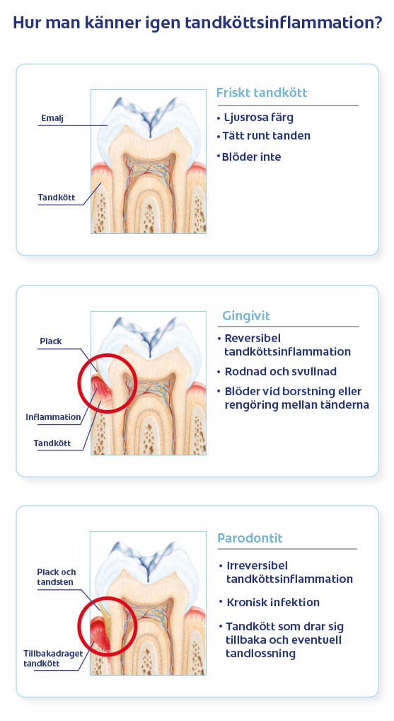 Hur man känner igen tandköttsinflammation?