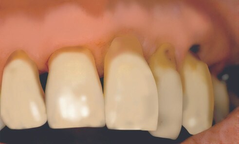 Exponerade rotytor  är mer sårbara