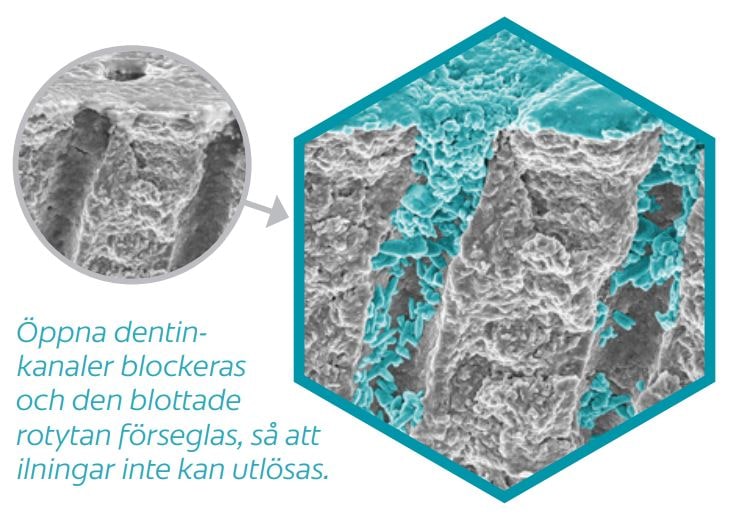 Ilningar i tänderna är ofta smärtsamma