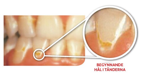 BEGYNNANDE HÅL I TÄNDERNA