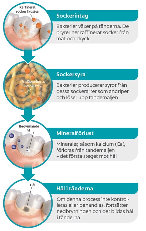 Vad orsakar hål i tänderna?
