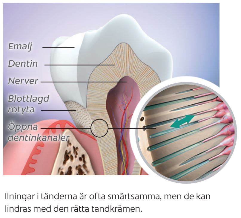 Ilningar i tänderna är ofta smärtsamma